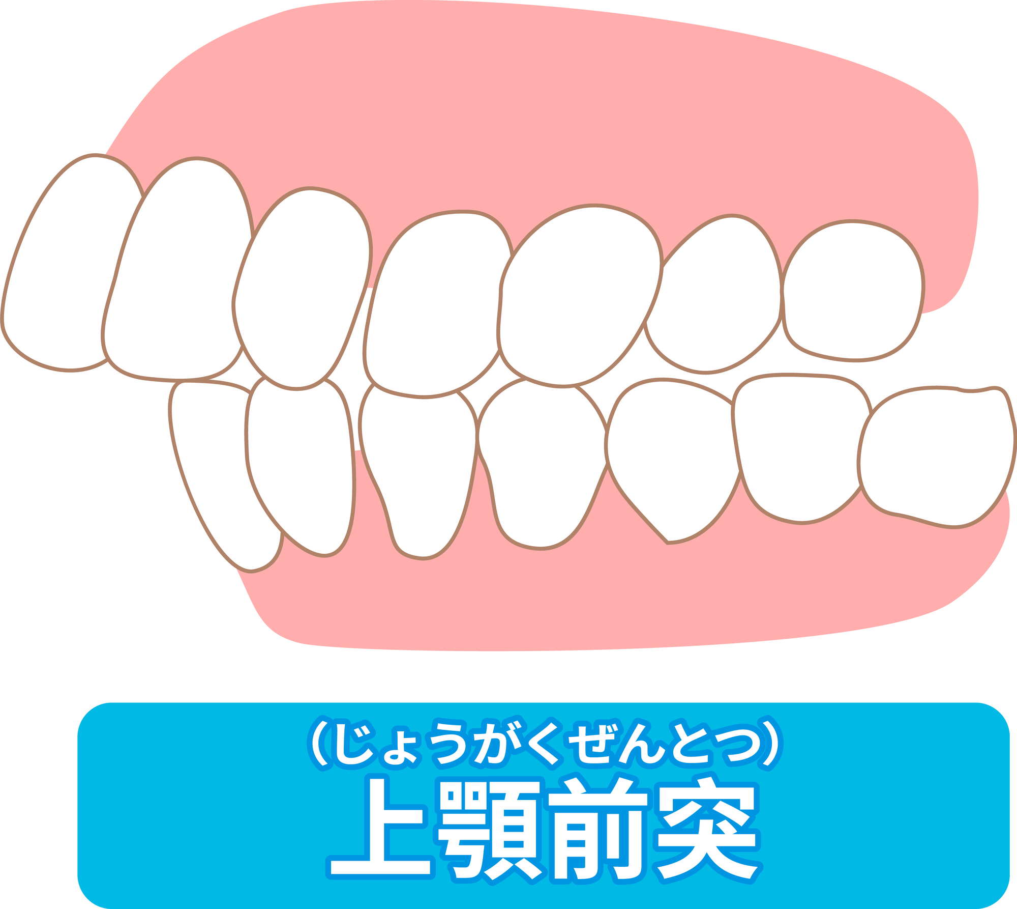 出っ歯（上顎前突）│大府市の歯医者・大府東歯科